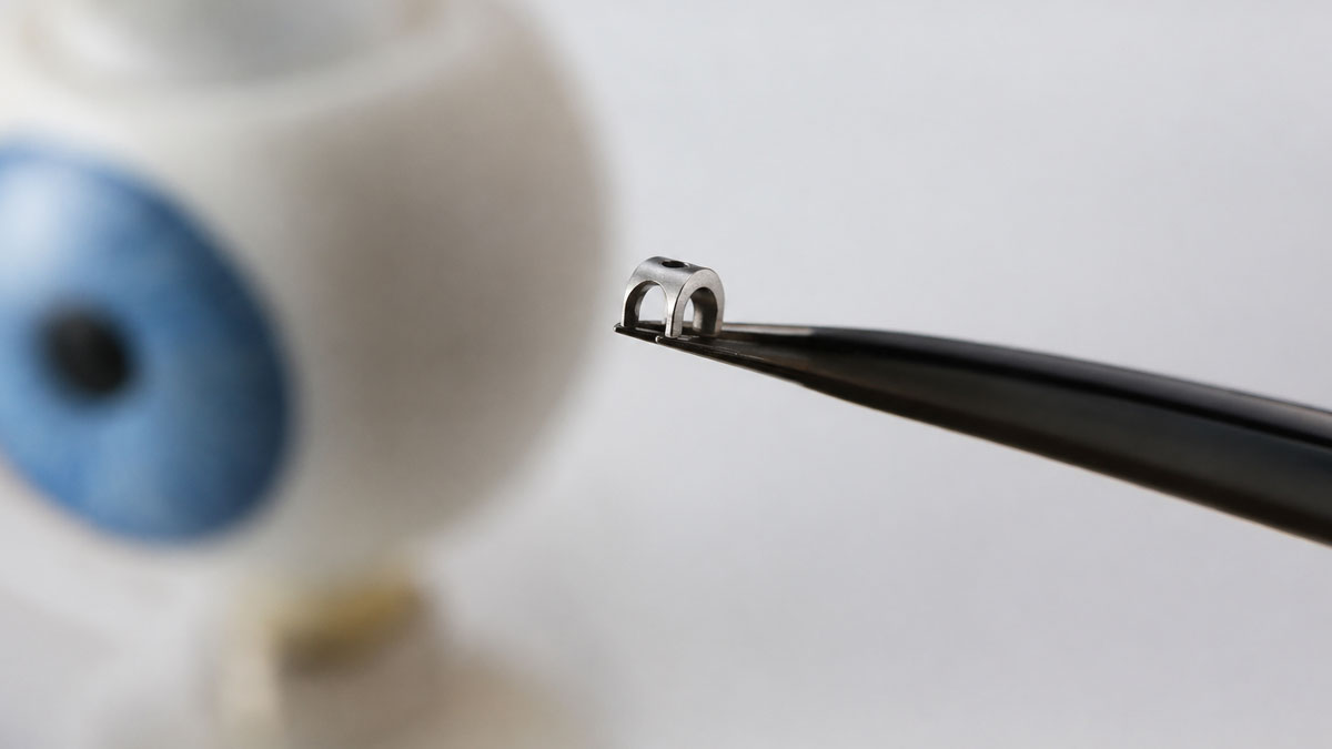 micro-stent iStent dans le cadre du traitement du glaucome